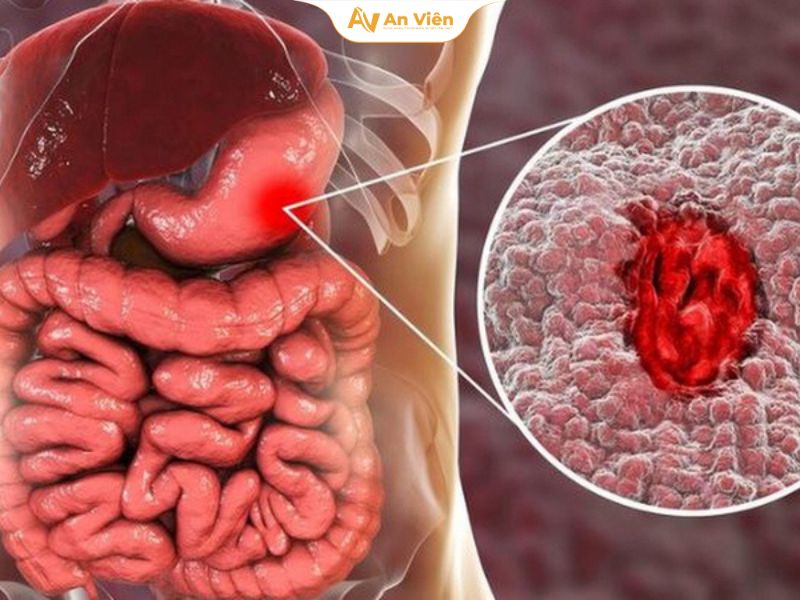 Giãn tĩnh mạch thực quản độ 2 là gì? Nguyên nhân, triệu chứng và phương pháp điều trị hiệu quả 8 Nhoi mau nao 14