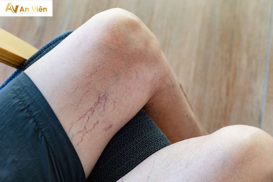 Bà bầu phù chân mấy lần thì sinh? Giải đáp dưới góc độ y khoa 7 Suy giãn tĩnh mạch chân thai kỳ