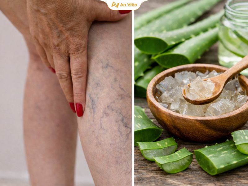 Chữa giãn tĩnh mạch bằng nha đam: Hiệu quả thật không? 12 Chữa giãn tĩnh mạch bằng nha đam có thực sự hiệu quả không?