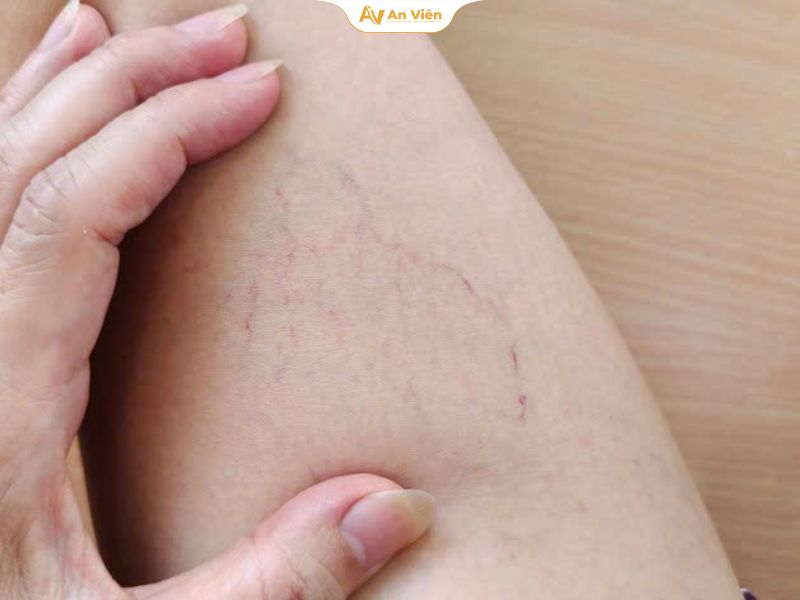 Giãn tĩnh mạch là tình trạng các tĩnh mạch, phổ biến nhất ở chi dưới, bị giãn rộng