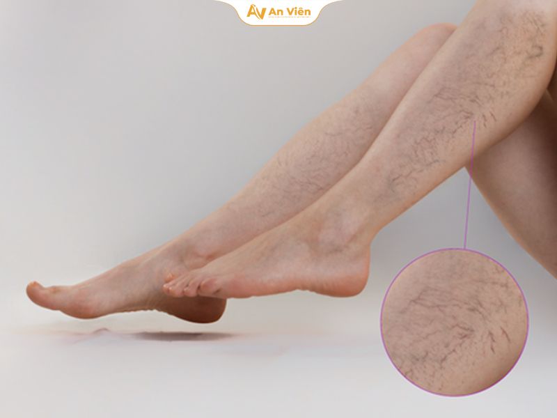 Giãn tĩnh mạch mạng nhện là gì? Nguyên nhân, triệu chứng và cách điều trị hiệu quả 9 uất hiện các mạch máu nhỏ hình mạng nhện dưới da