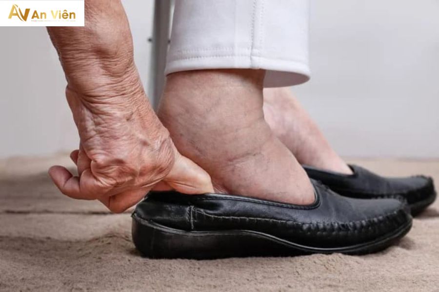 Hiện tượng phù chân ở người già