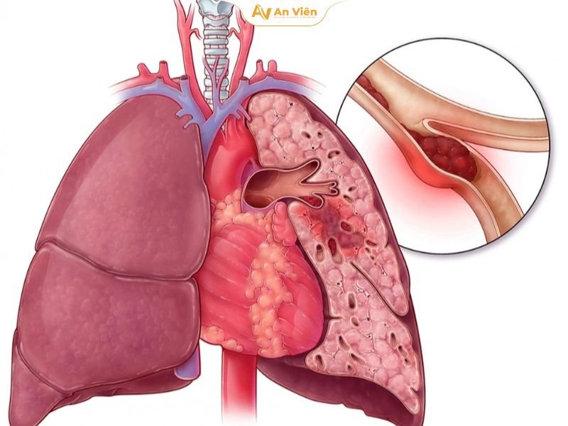 Thuyên tắc phổi 