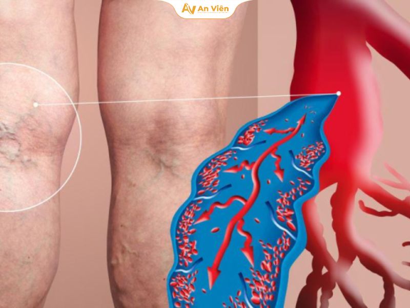 Nguyên nhân gây huyết khối tĩnh mạch sâu chi dưới