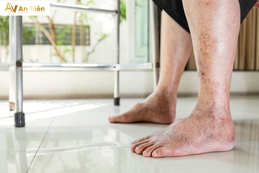 Người già bị phù chân nên làm gì? Giải pháp an toàn và hiệu quả từ chuyên gia 7 Phù chân ở người già là gì?
