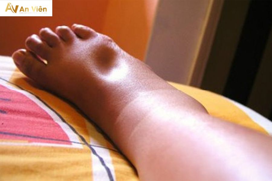 Phù chân ấn lõm là gì? Phân độ và mức độ nguy hiểm 6 Nguyên nhân dẫn đến phù chân ấn lõm