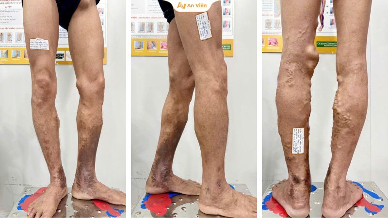 Dấu hiệu sớm suy giãn tĩnh mạch