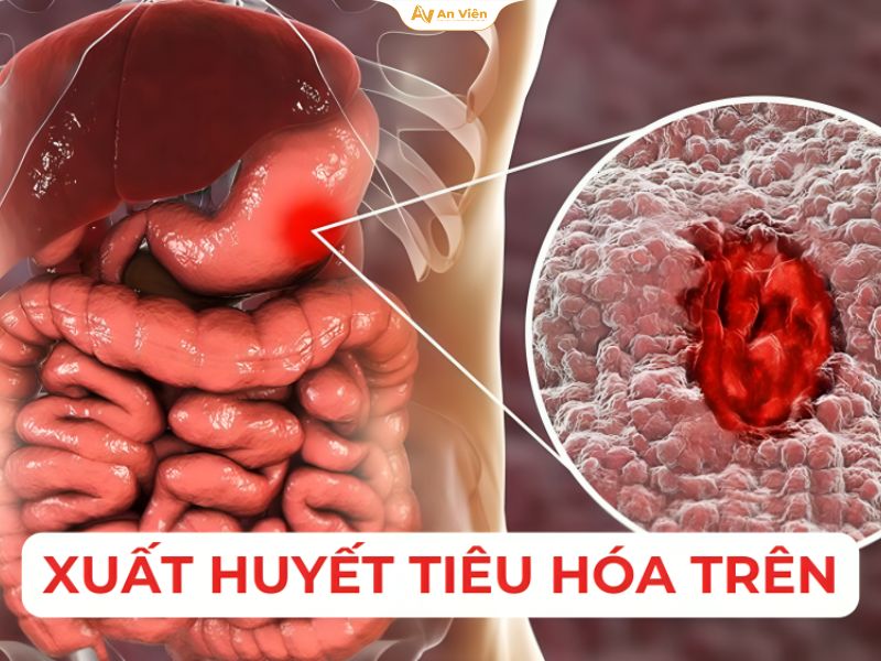 Giãn tĩnh mạch thực quản độ 1