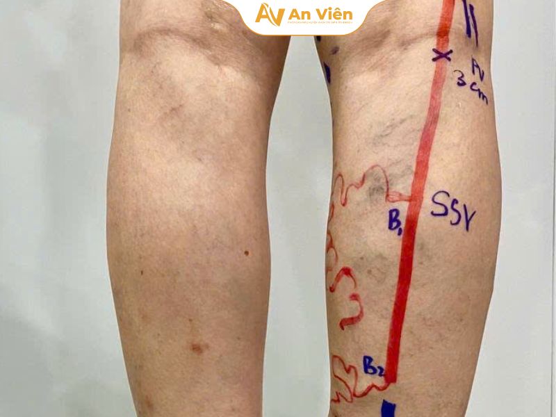 Thực hư việc "trị dứt điểm suy giãn tĩnh mạch" chỉ sau 45 phút 4 suy-gian-tinh-mach