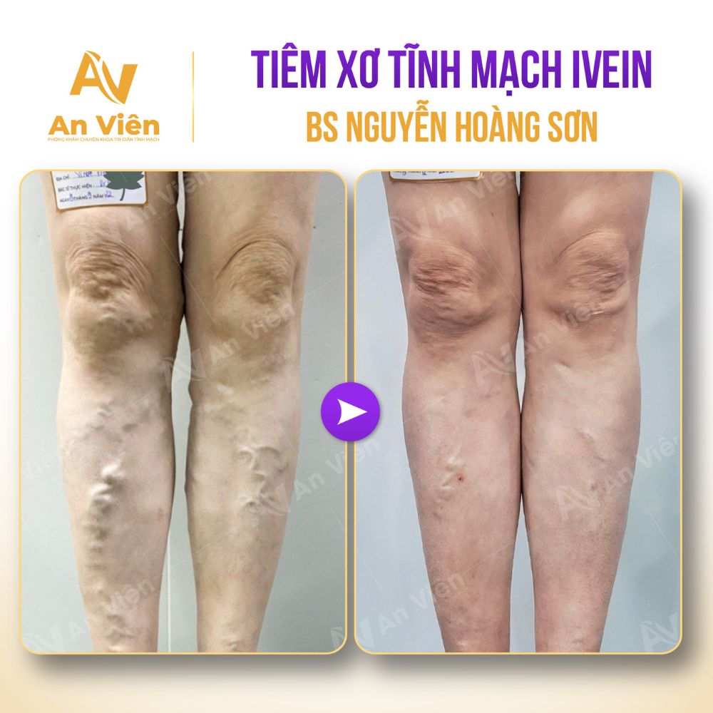 Giãn tĩnh mạch chỉ nổi gân xanh