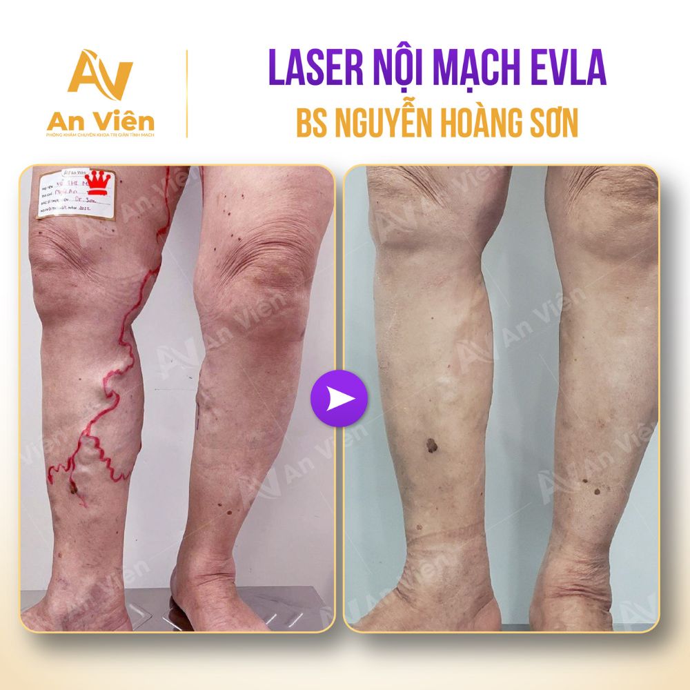 Giãn tĩnh mạch chỉ nổi gân xanh