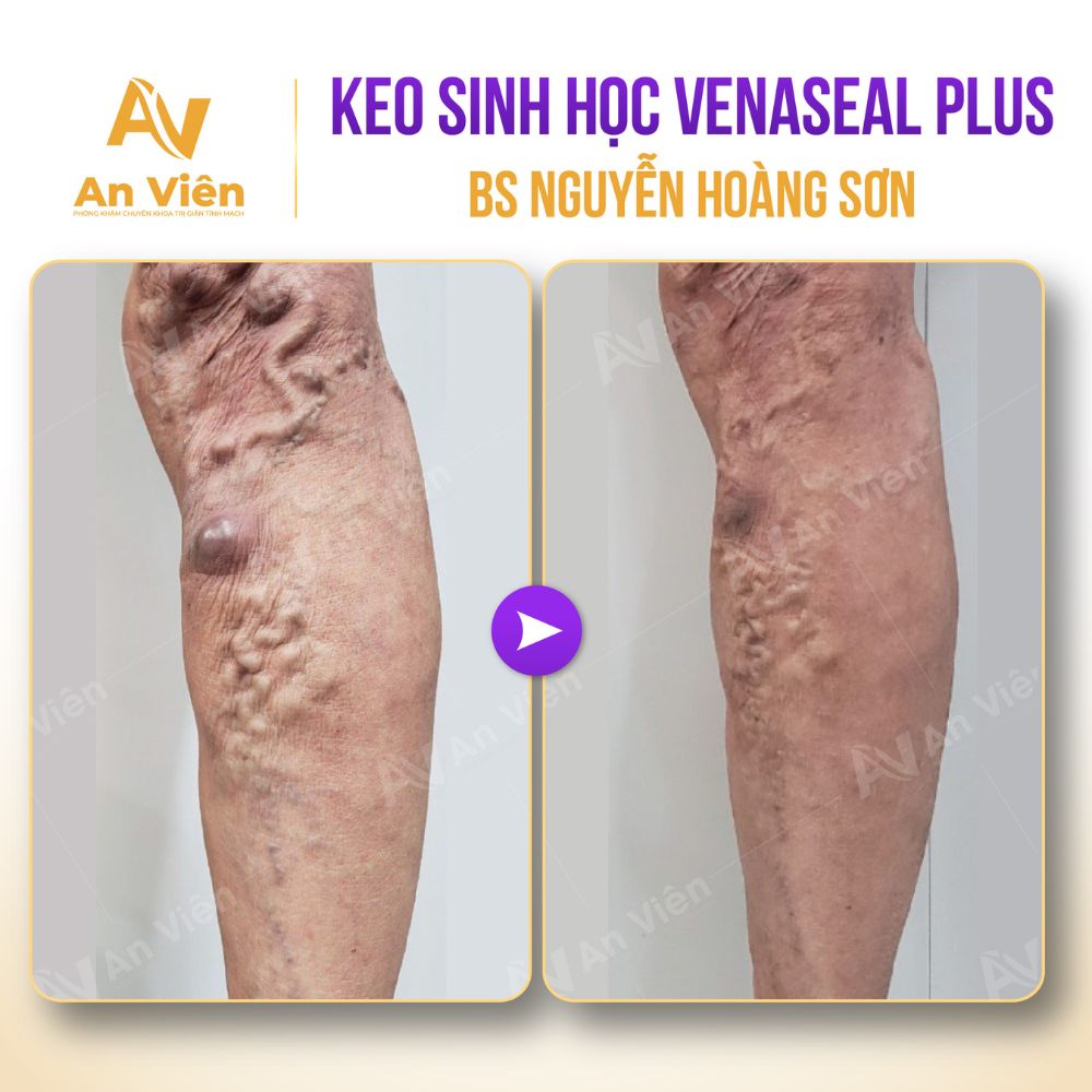 Giãn tĩnh mạch chỉ nổi gân xanh 