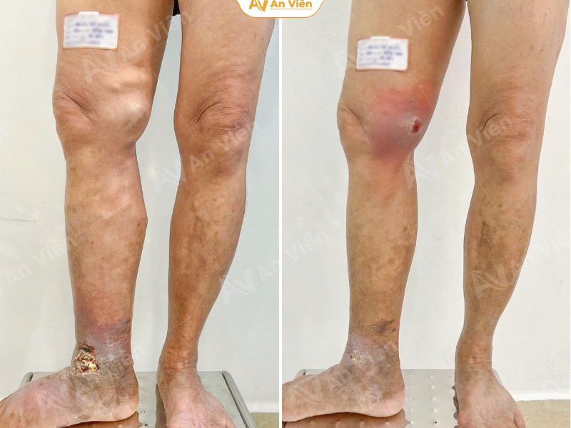 Kỳ tích từ An Viên: Khi một đôi chân được “trao lại” như phép màu 4 ky-tich-tai-an-vien