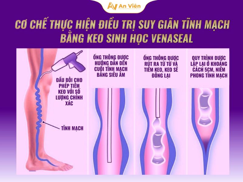 Bị giãn tĩnh mạch nên làm gì? Chìa khóa nằm ở 5 thói quen đơn giản sau đây 12 Bị giãn tĩnh mạch nên làm gì