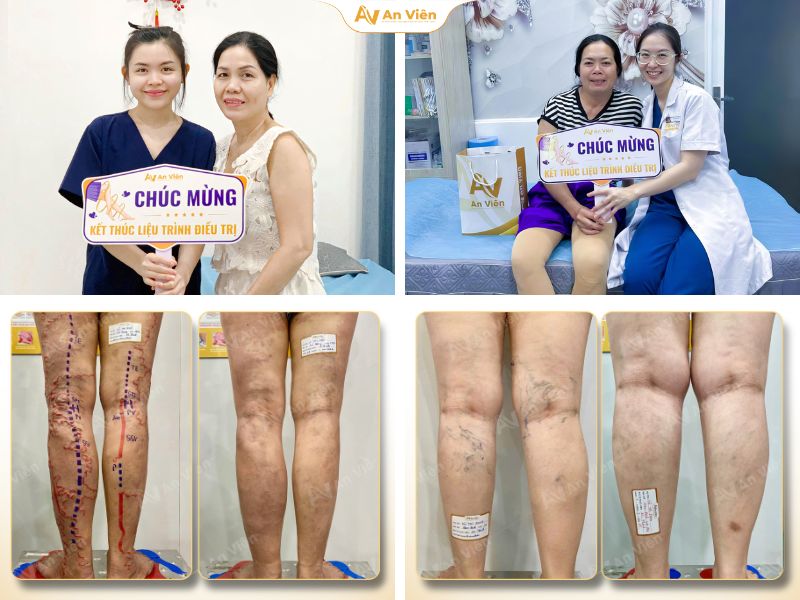 Bị giãn tĩnh mạch nên làm gì? Chìa khóa nằm ở 5 thói quen đơn giản sau đây 14 Bị giãn tĩnh mạch nên làm gì