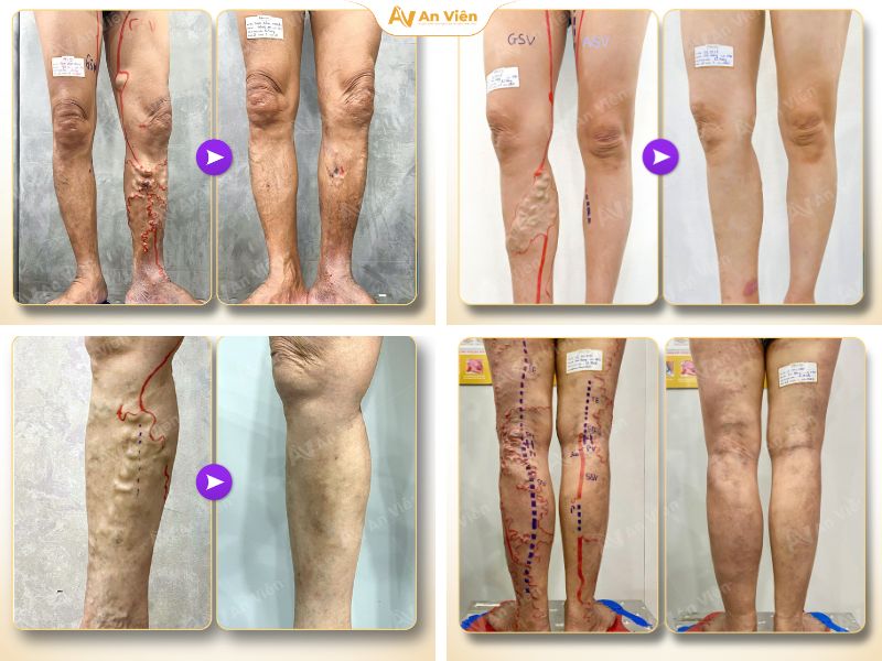 Điều trị suy giãn tĩnh mạch