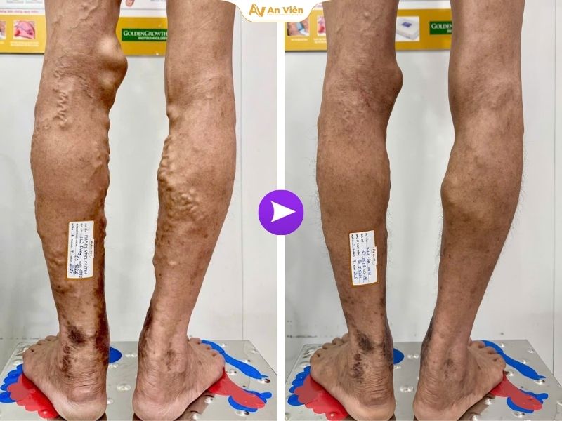 Loét tĩnh mạch – góc nhìn chuyên sâu và giải pháp hiệu quả từ An Viên 6 Loét tĩnh mạch