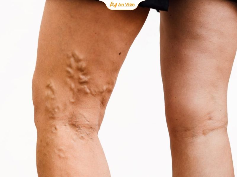Suy giãn tĩnh mạch hiển lớn