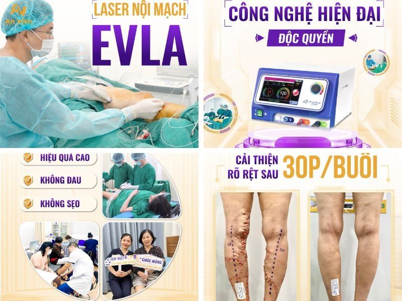 Chi phí điều trị giãn tĩnh mạch bằng laser