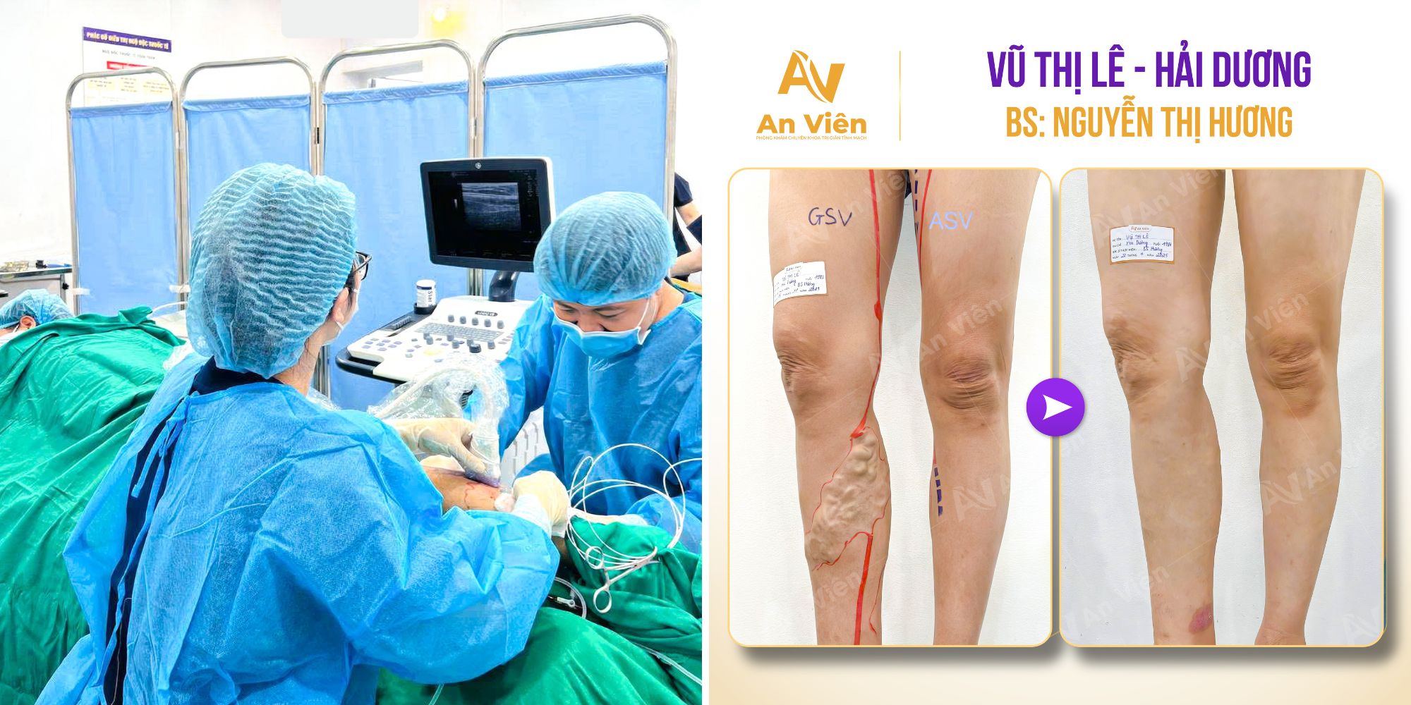 Búi tĩnh mạch dai dẳng như đỉa, thuốc uống mãi không khỏi - An Viên mang lại cơ hội hồi phục không ngờ 6 An Viên