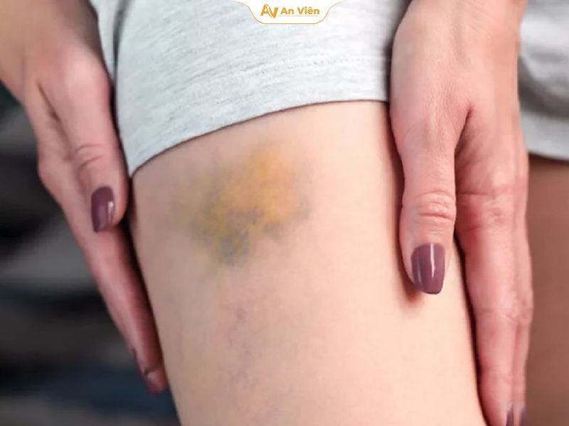 Dấu hiệu vỡ mạch máu dưới da