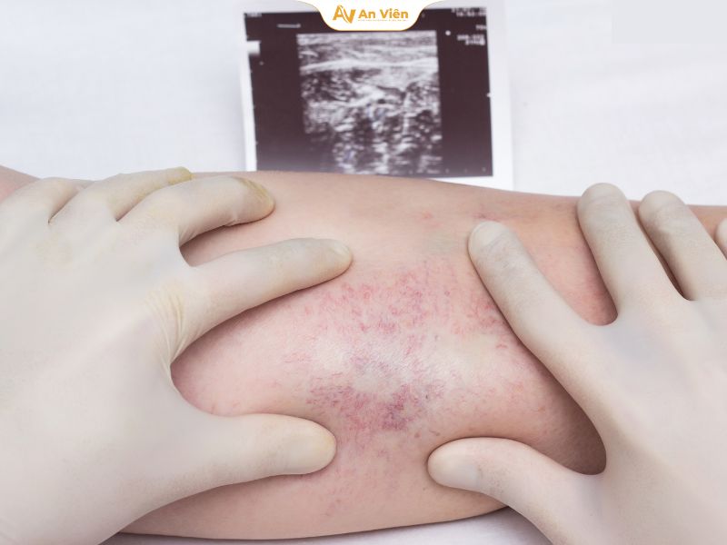 Dấu hiệu vỡ mạch máu dưới da