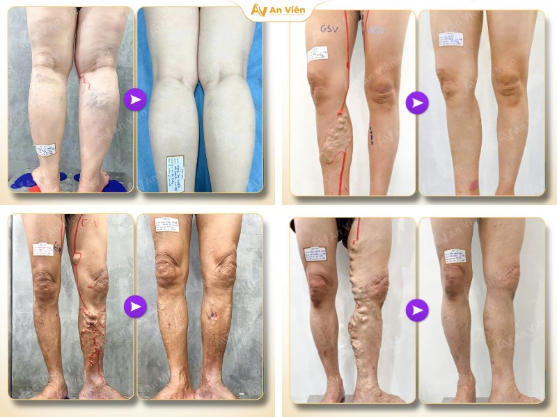 Nhiều người Việt nghĩ đau chân là chuyện nhỏ – Thực tế đó có thể là dấu hiệu giãn tĩnh mạch báo động 14 Giãn tĩnh mạch