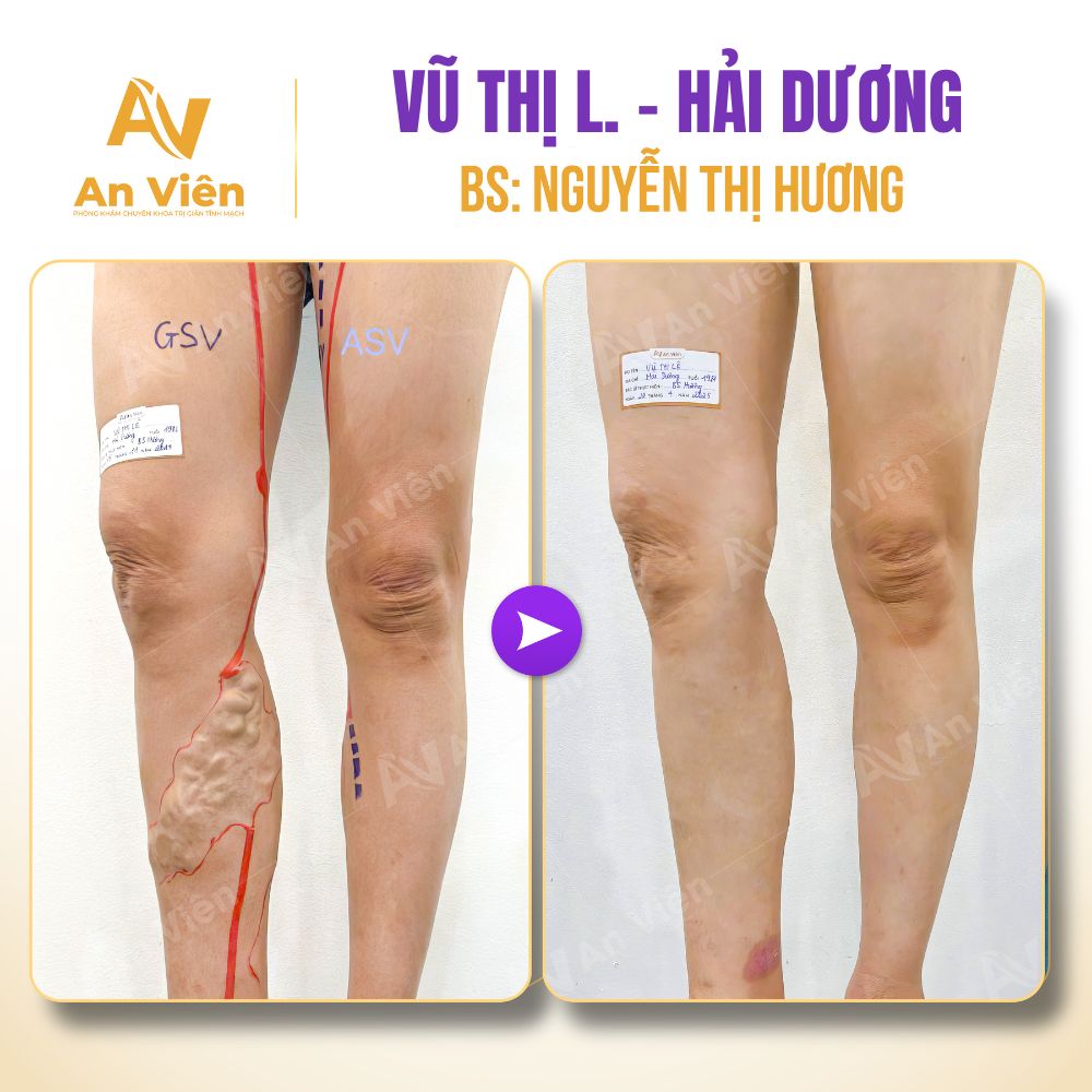 Giảng dạy liên tục cả buổi, chân đau nhức búi giãn nổi khiến mỗi bước đi trở thành cực hình 6 Suy giãn tĩnh mạch