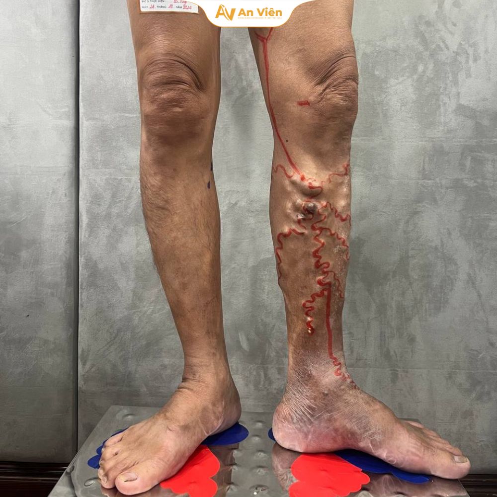 Sốc với ca suy giãn tĩnh mạch 20 năm không thể chữa khỏi – An Viên "xóa sổ" gọn nhẹ chỉ với 1 liệu trình 4 Suy giãn tĩnh mạch