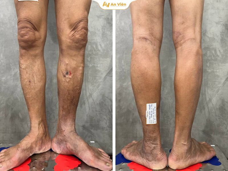 Công nghệ chữa suy giãn tĩnh mạch: An toàn, ít đau, hồi phục nhanh 11 Chân bệnh nhận hồi phục gần như hoàn toàn sau khi tiến hành điều trị bằng laser EVLA kết hợp tiêm xơ IVEIN