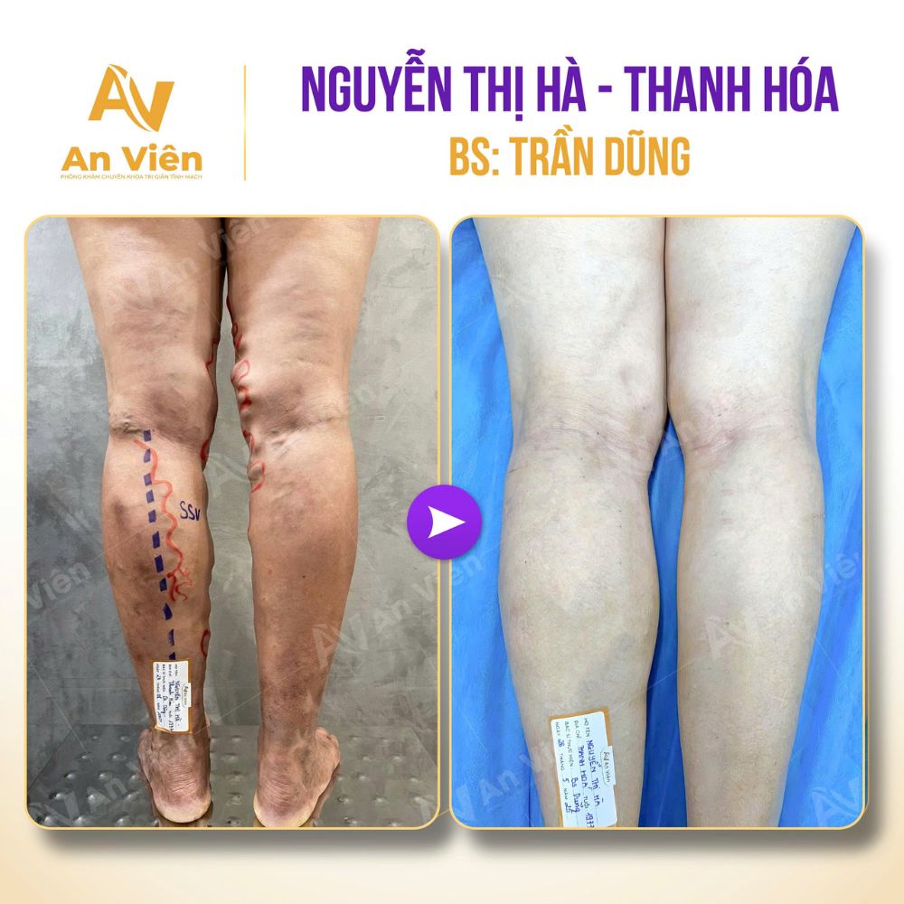 Suy giãn tĩnh mạch