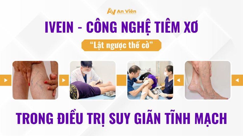Suy giãn tĩnh mạch có cần nằm viện không? Giải đáp chuyên khoa 9 Tiêm xơ tĩnh mạch