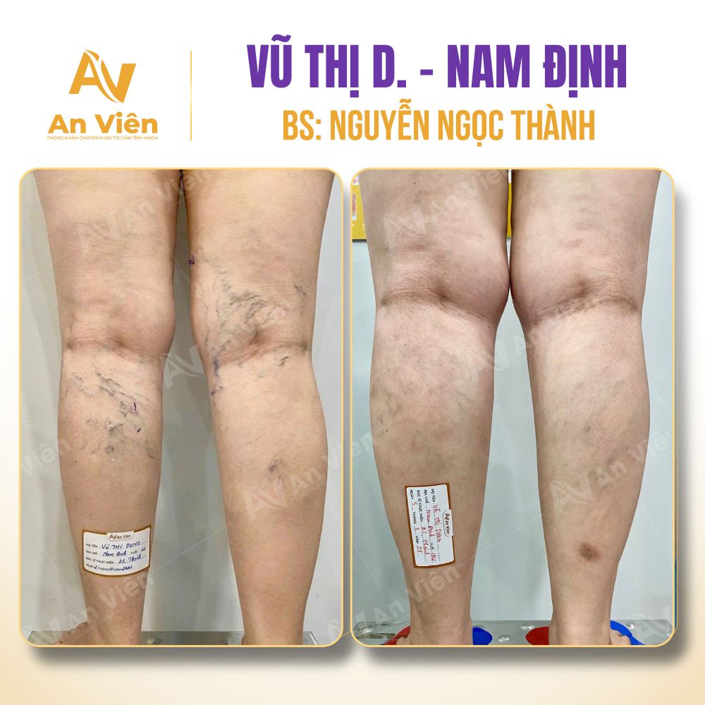 Nữ nhân viên văn phòng nổi gân xanh, chuột rút chân suốt gần 3 năm đi khám phát hiện bệnh lý tĩnh mạch dễ bỏ sót 5 Tĩnh mạch