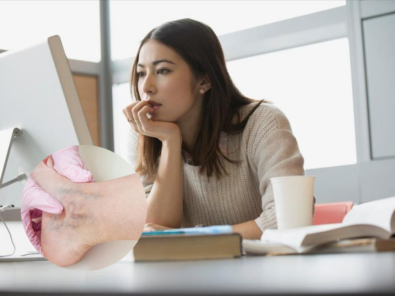 Ngồi nhiều, lười vận động: Dân văn phòng rơi vào ‘bẫy’ suy giãn tĩnh mạch bao giờ không hay 11 suy-gian-tinh-mach