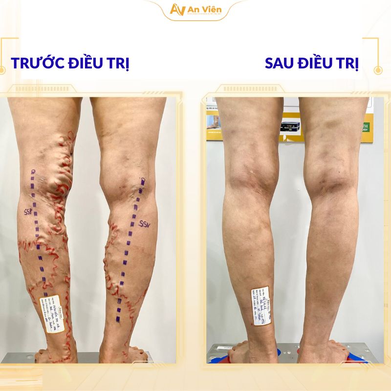 Người phụ nữ và hành trình thoát khỏi đôi chân chằng chịt gân xanh ngoằn ngoèo 5 thoat-khoi-doi-chan-chang-chit-gan-xanh