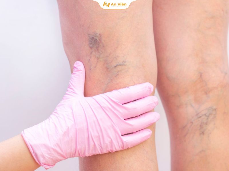 Áp dụng cho bệnh nhân suy giãn tĩnh mạch