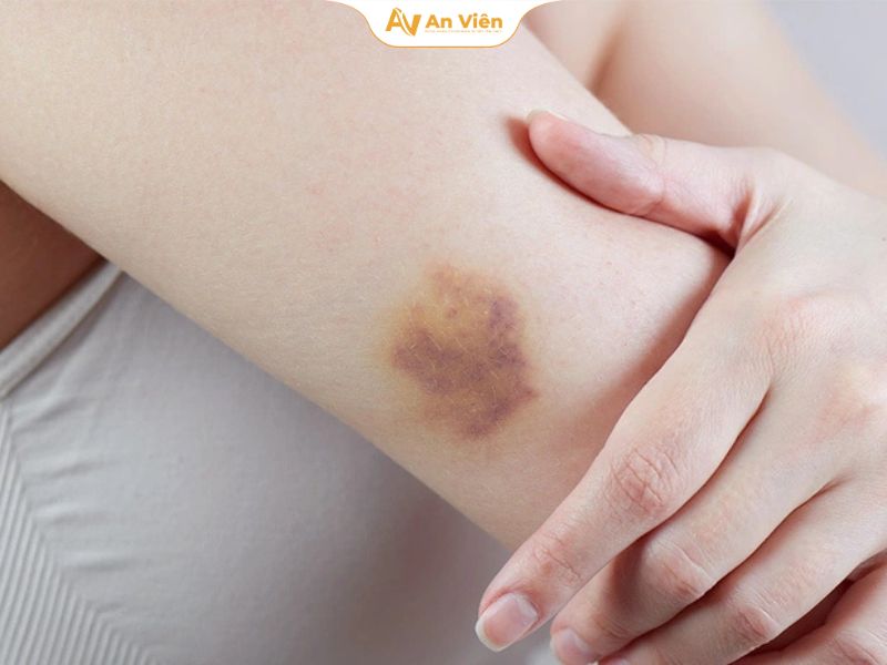 Vỡ mạch máu dưới da ở người trẻ là gì? Có nguy hiểm không? 8 vo-mach-mau-o-nguoi-tre