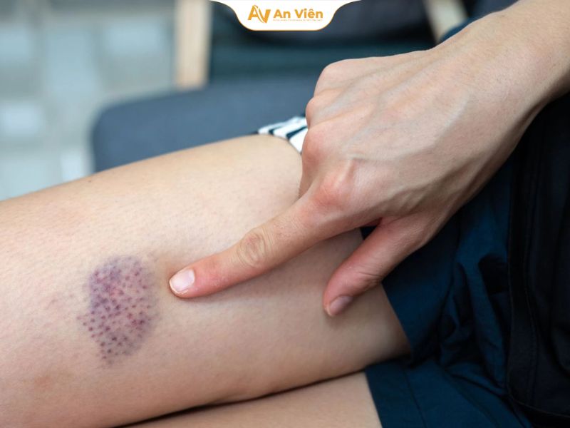 Vỡ mạch máu dưới da ở người trẻ là gì? Có nguy hiểm không? 9 vo-mach-mau-o-nguoi-tre