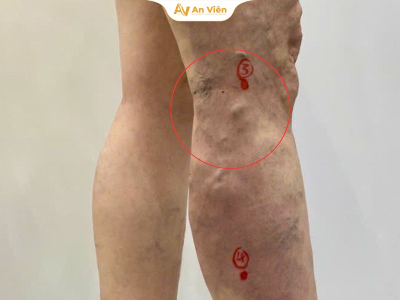 5 điều về suy giãn tĩnh mạch mà bạn có thể chưa biết 7 vo-mach-mau-o-nguoi-tre