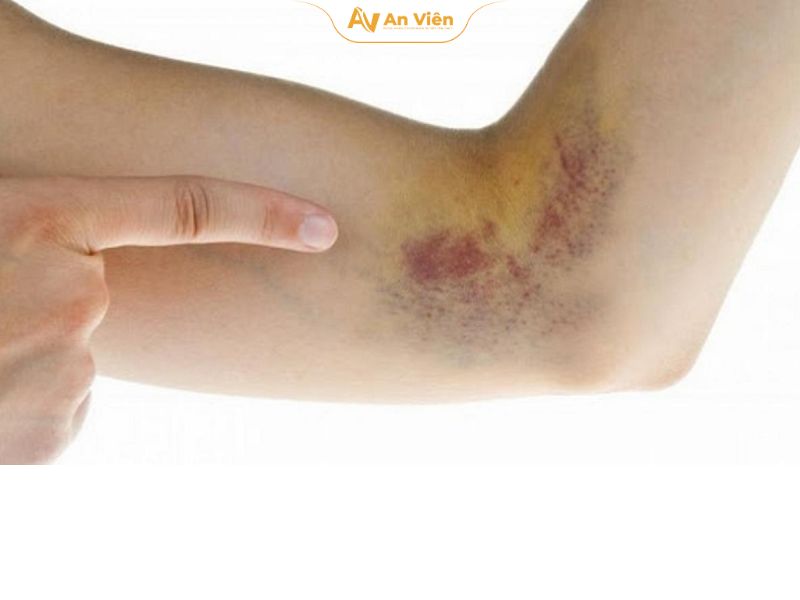 Vỡ mạch máu dưới da ở người trẻ là gì? Có nguy hiểm không? 7 vo-mach-mau-o-nguoi-tre