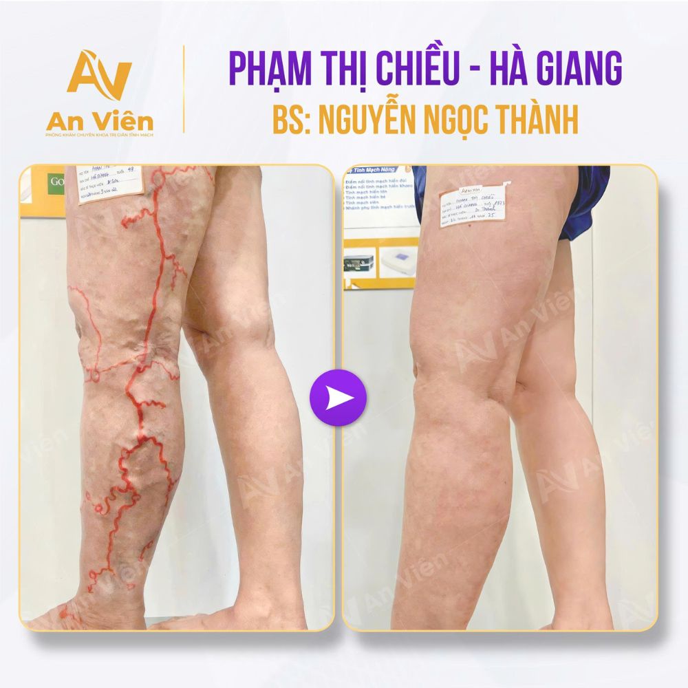 3 năm kiên trì, 1 cái kết mỹ mãn: U50 thoát khỏi dị dạng tĩnh mạch tại An Viên 6 An Viên