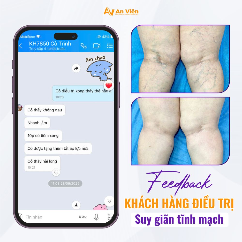 Béo phì và Suy giãn tĩnh mạch: Bộ đôi đáng sợ tàn phá sức khỏe đôi chân 10 Béo phì và suy giãn tĩnh mạch
