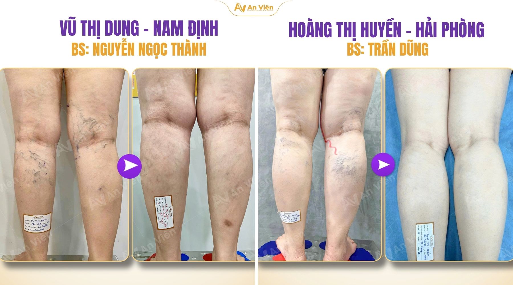 Béo phì và Suy giãn tĩnh mạch: Bộ đôi đáng sợ tàn phá sức khỏe đôi chân 9 Béo phì và suy giãn tĩnh mạch