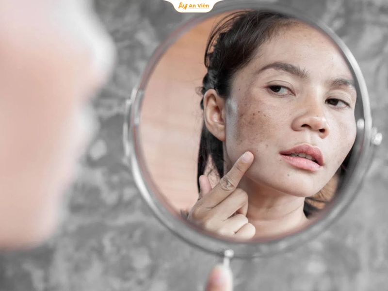 Các cách trị rối loạn sắc tố da tại nhà phổ biến và điều ít ai nói với bạn 12 Cách trị rối loạn sắc tố da tại nhà