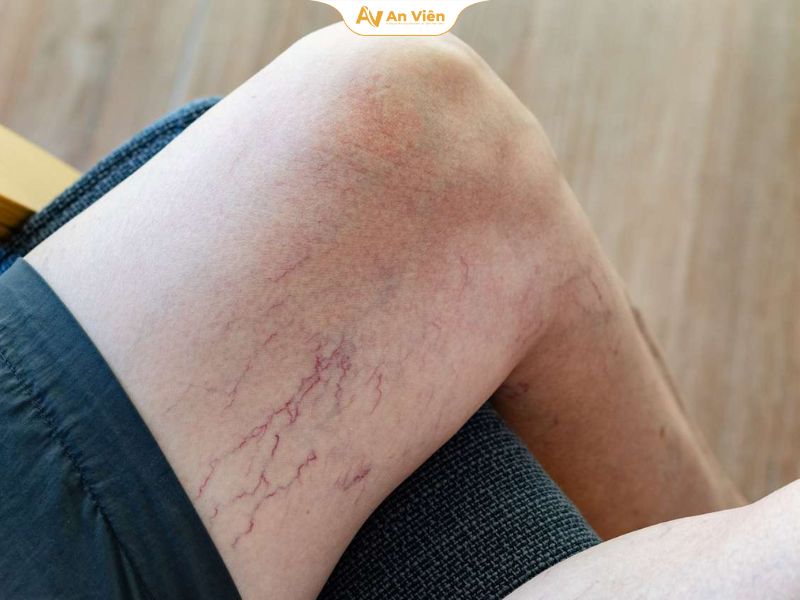 Giãn tĩnh mạch bẩm sinh là gì? Cảnh báo sớm và cách điều trị an toàn 10 Giãn tĩnh mạch bẩm sinh