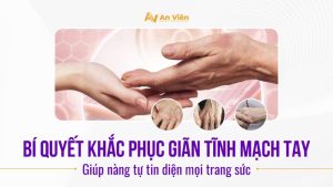 Giãn tĩnh mạch tay