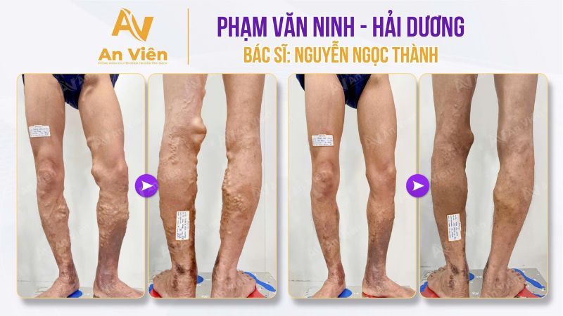 Góc nhìn chuyên gia: Suy giãn tĩnh mạch không còn là “bệnh của thế giới tiên tiến” – Việt Nam đã làm chủ công nghệ và kỹ thuật điều trị 7 Suy giãn tĩnh mạch