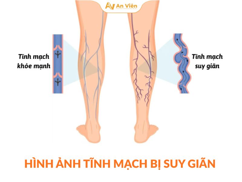 5 thói quen phổ biến khiến 60% người Việt Nam mắc suy giãn tĩnh mạch mà không hề biết 6 an-vien