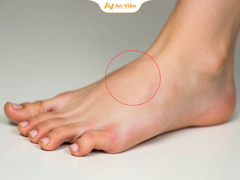 Phù chân voi là gì? Khi nào cần thăm khám và điều trị? 11 phu-chan-voi-la-gi