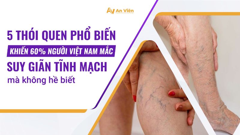 5 thói quen phổ biến khiến 60% người Việt Nam mắc suy giãn tĩnh mạch mà không hề biết 7 suy-gian-tinh-mach